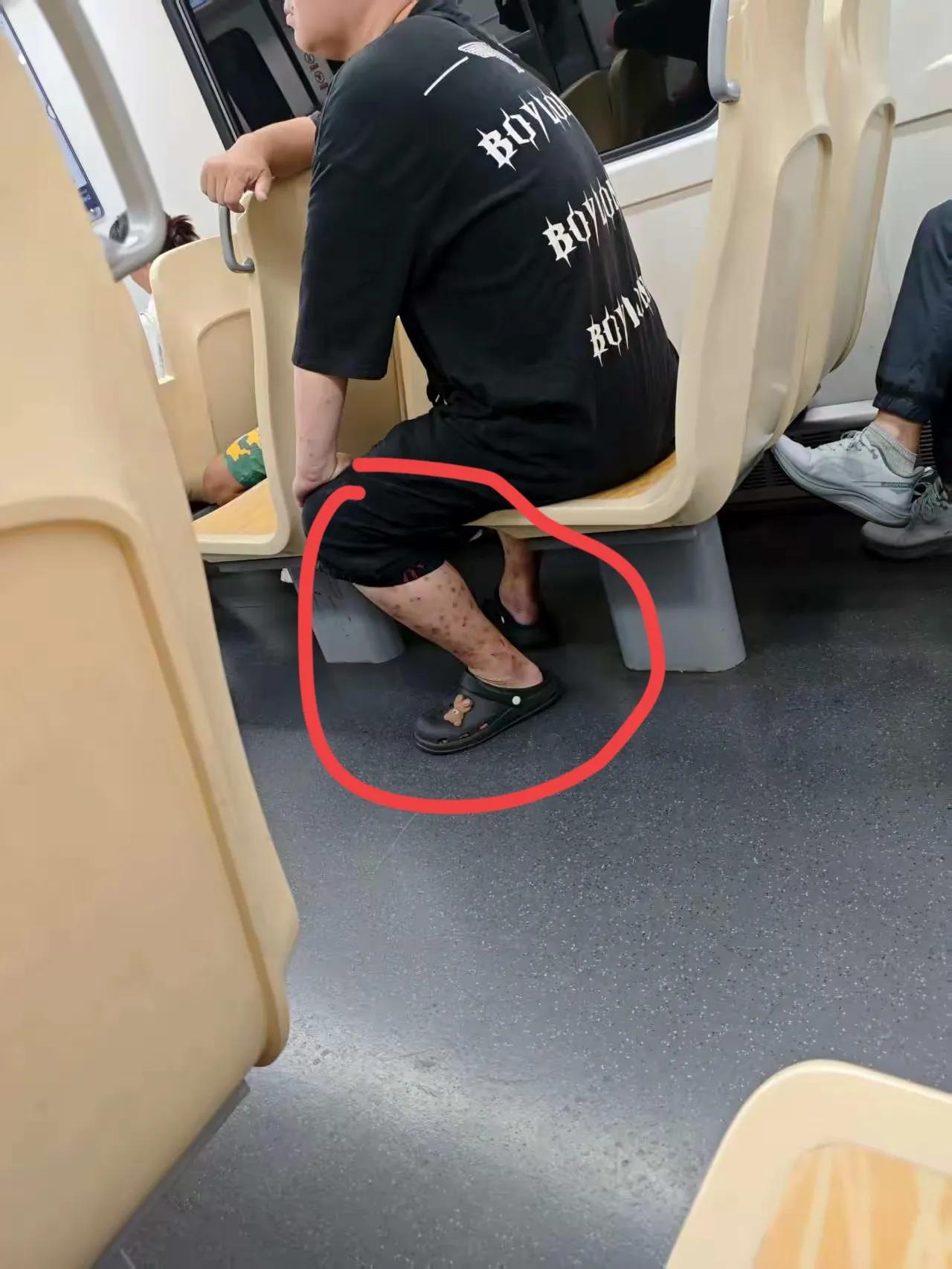 坐公交车时，我看到有人身上长着一种皮肤病，症状为密密麻麻的样子，看起来十分吓人，