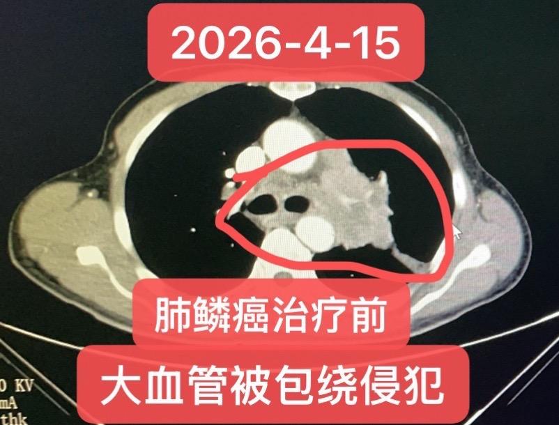 局部晚期肺鳞癌的新辅助治疗。患者，男，57岁，临床分期：T4N2M0...