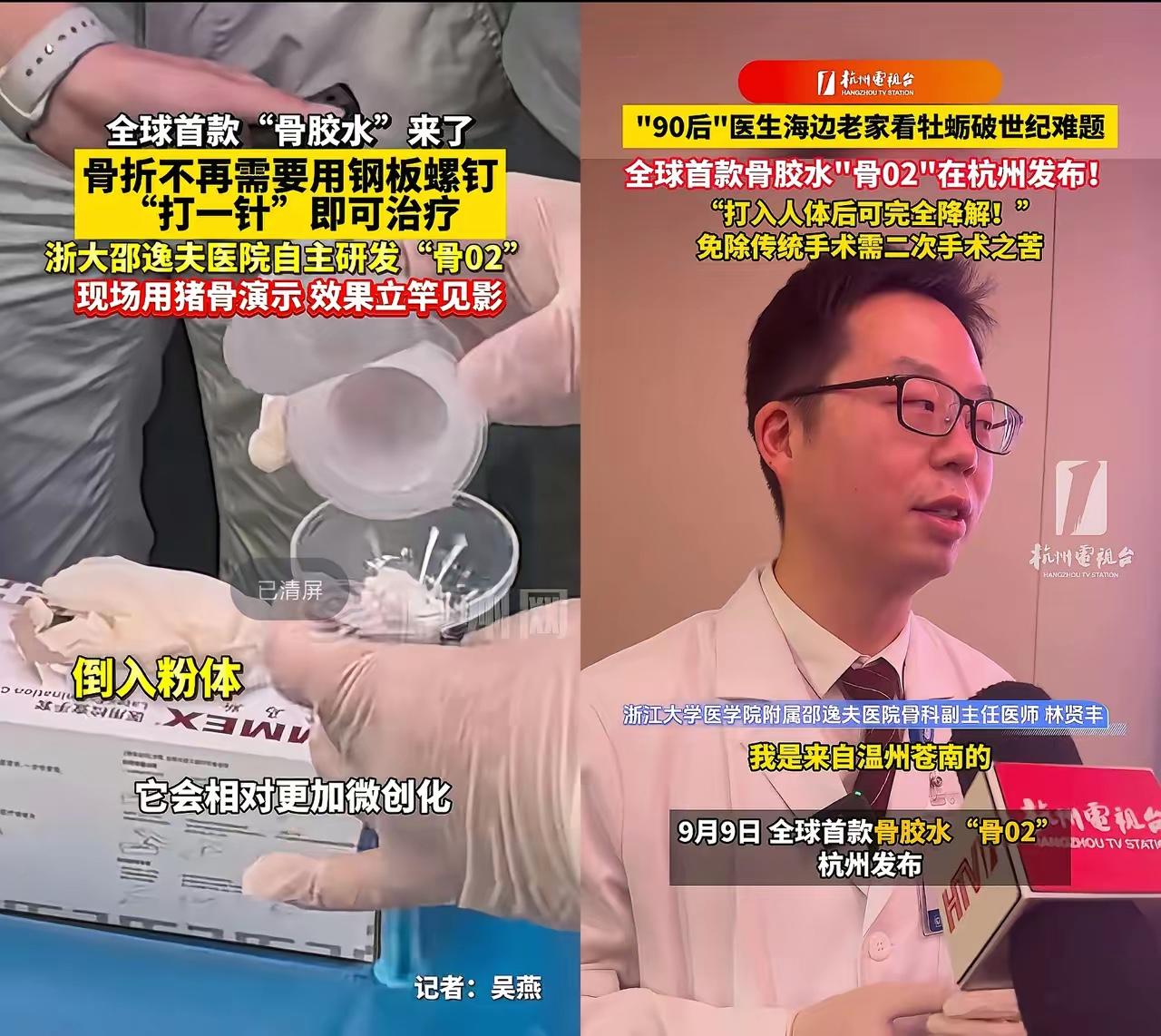全球首款“骨胶水”横空出世！浙江这家医院太牛了不仅中国，连全世界都要知道了。