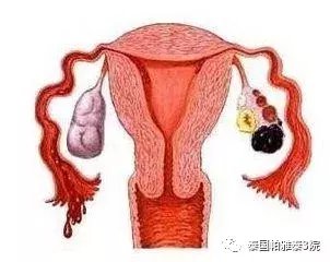 大肌瘤妈妈的带瘤怀孕故事