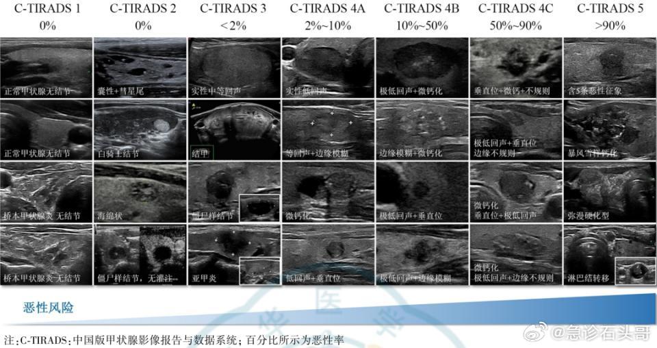 中庸之道才是健康的根基      甲状腺癌很多人都觉得是懒癌，不当回事...