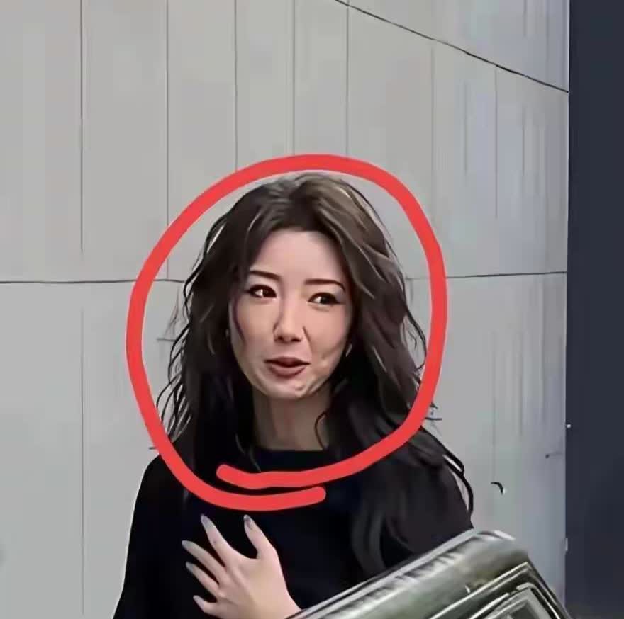 37岁毛晓彤医美后遗症，前脸肿胀，嘴唇周边小疙瘩，浓妆都遮不住