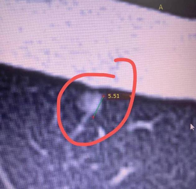 门诊来了个14岁的小男孩，我一开始还以为是来看漏斗胸的。结果他妈妈告诉我，其实是