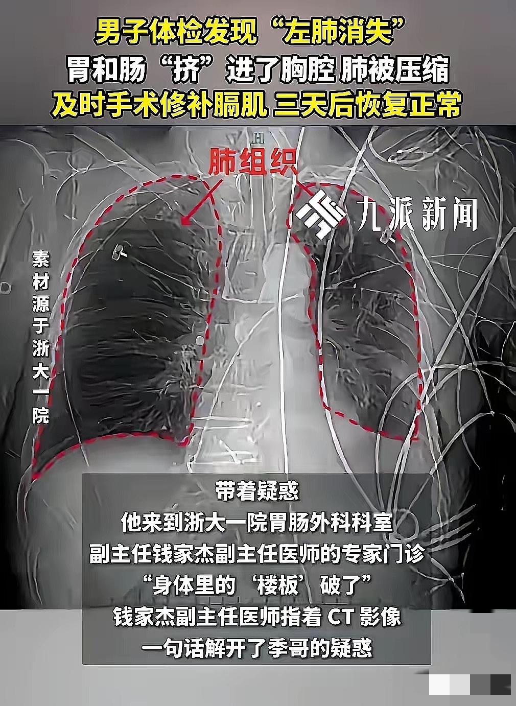 “这运气简直逆天！”浙江季先生抽奖中了免费体检，没成想查出个“大隐患”——CT片