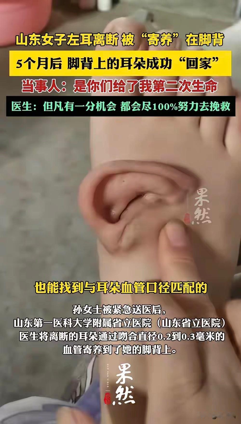 长在脚背上的耳朵，堪称医学奇迹！山东女子一次意外中耳朵掉落，本以为自卑地带着一只