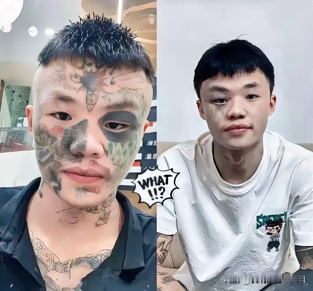 06年的广东男孩夏勇，正咬着牙挨第五次激光洗纹身——三次下来，脸上那道13岁时纹
