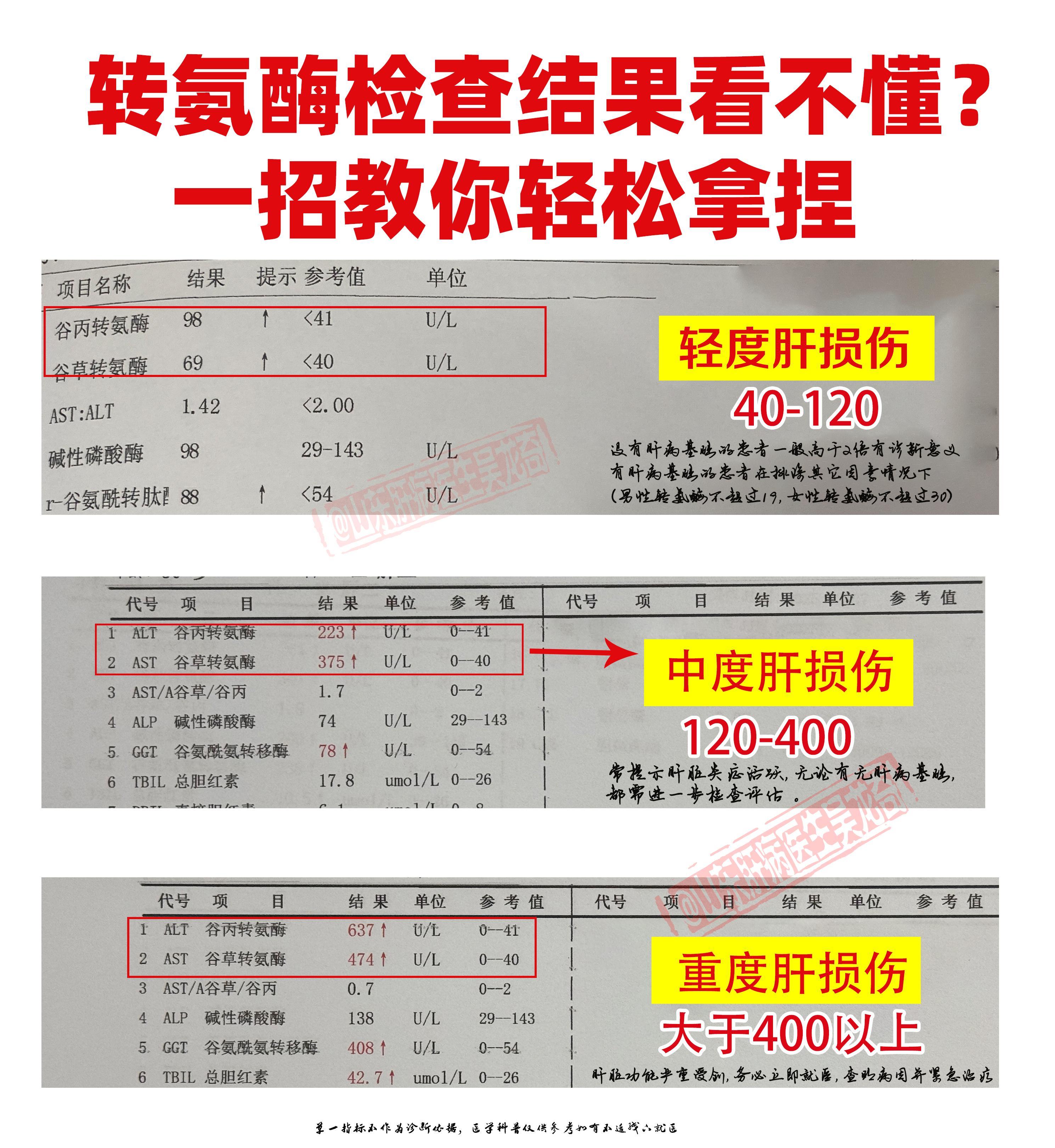 转氨酶检查结果看不懂？一招教你轻松拿捏！ 转氨酶升高数值反映肝损伤的严...