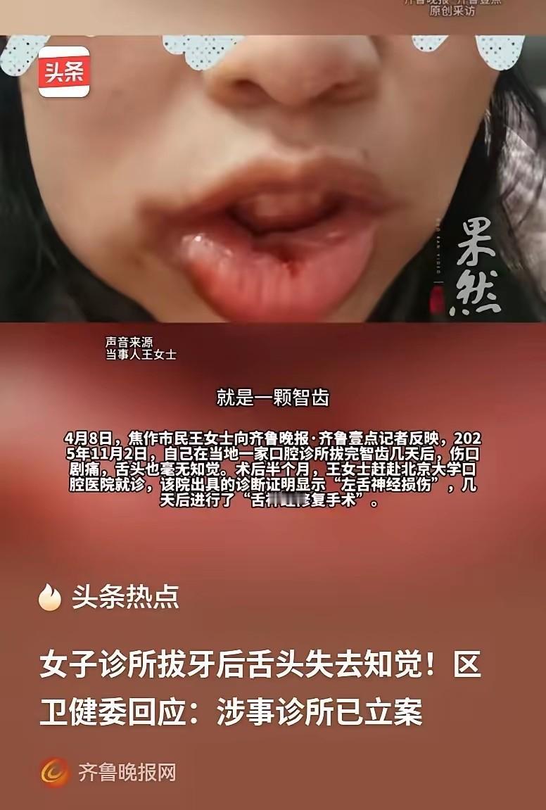 河南焦作，女子要备孕，就想提前把智齿拔掉，结果牙齿一拔，她整个舌头都没有知觉了，