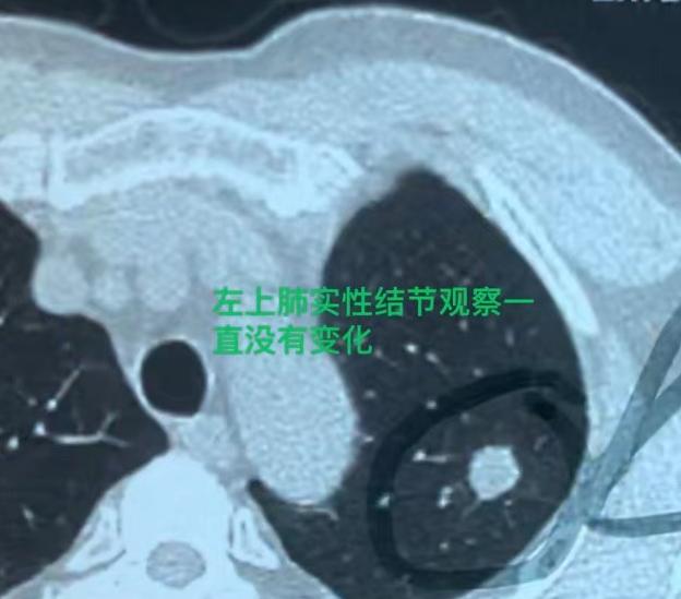 警惕！被忽视的肺实性结节，已发生转移！最近我接诊了一位66岁的男性患者，情况真的