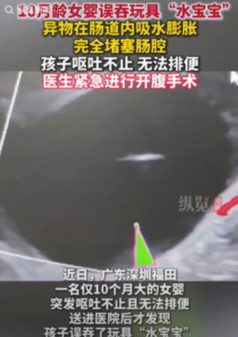 心不是一般的大！广东深圳，一10个月大的女婴，因呕吐和无法排便，被家人送到医院检