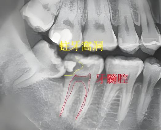 牙齿深龋需要根管治疗吗？不一定。一般需要拍片检查+打开牙齿去腐过程才确定。