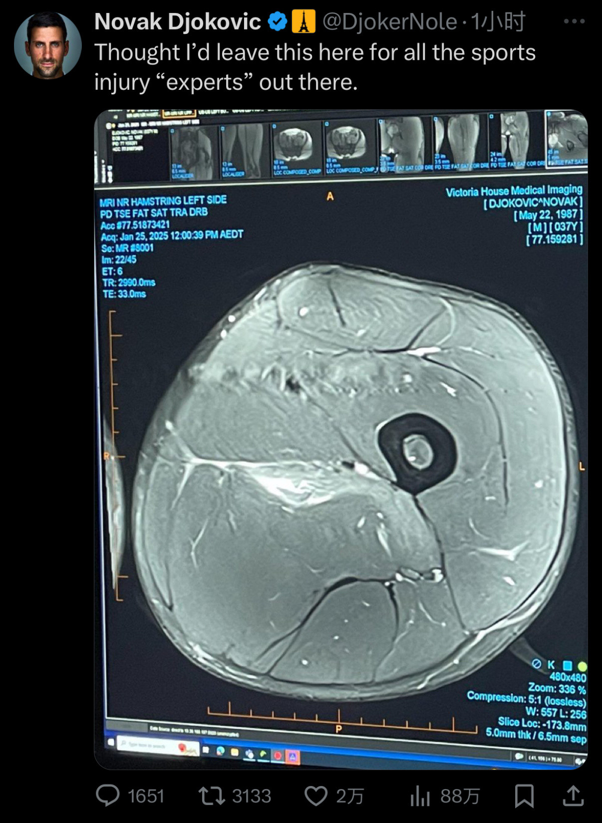 德约昨晚祝贺了澳网女单冠亚军后，不久后还贴出了一张自己的左大腿的核磁共振扫描图，