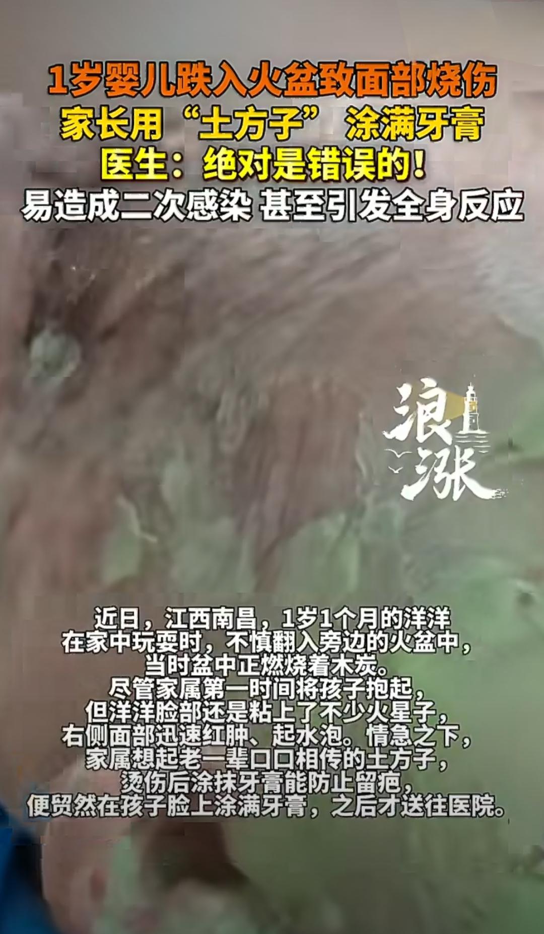 江西南昌，1岁1个月的洋洋在家中玩耍时，不小心翻进了旁边装着燃烧木炭的火盆。家人