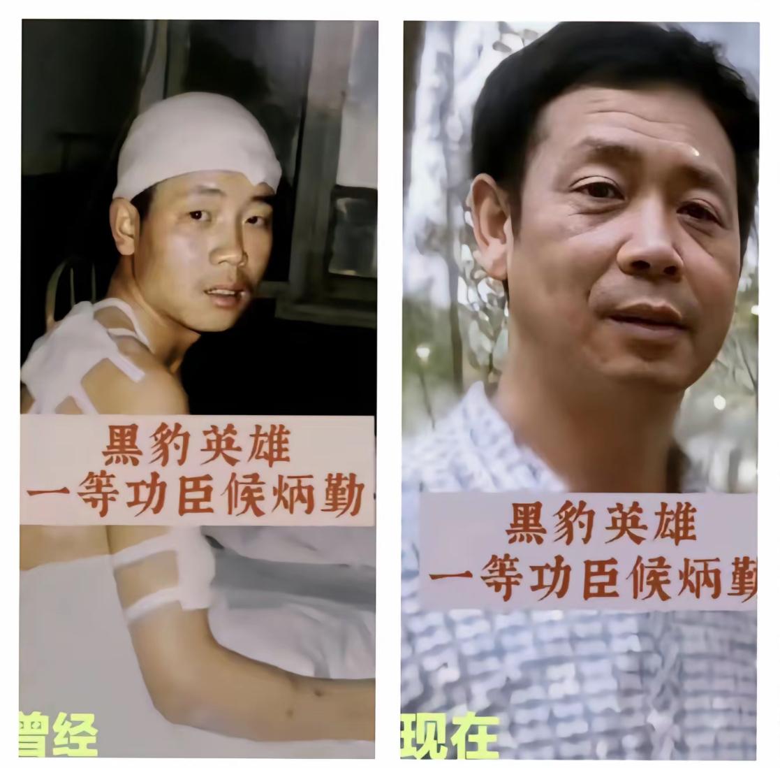 九死一生的突击英雄侯炳勤，这张照片是英雄在“黑豹行动”中全身多处被弹片击伤，在住