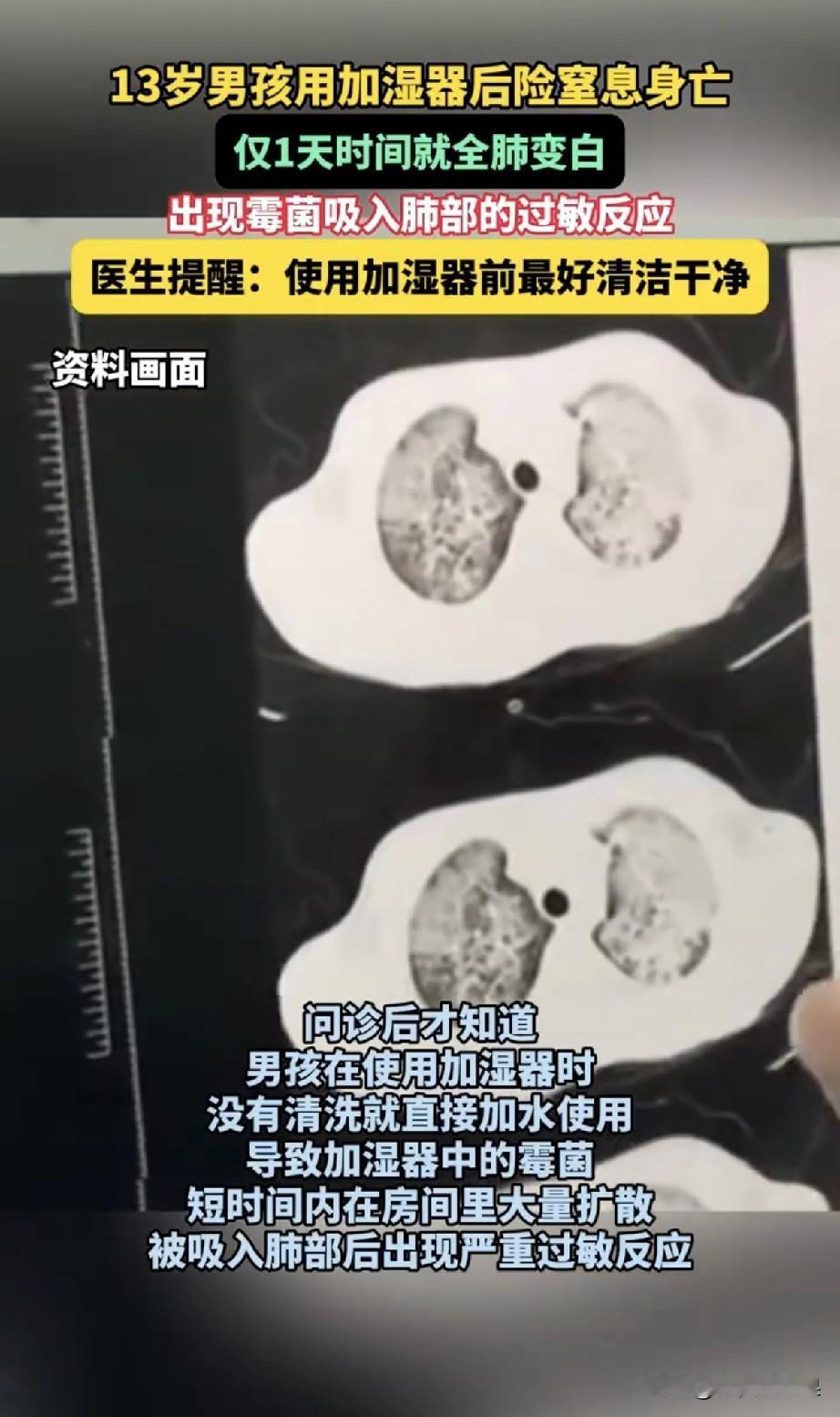 河南13岁男孩因使用不当加湿器，双肺全白被送ICU抢救！家人们，刷到这条的赶紧