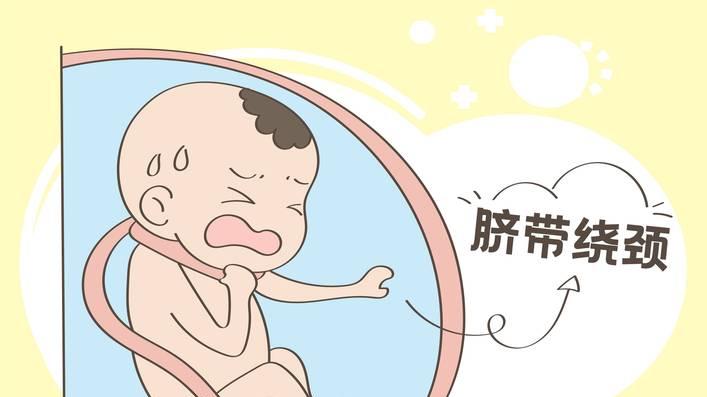 脐带绕颈必须剖腹产?产科医生告诉你真相