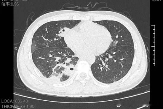 20岁男生挤了颗脸上的痘痘肺就出现10多个洞近日，浙江宁波，20岁的小林是名大
