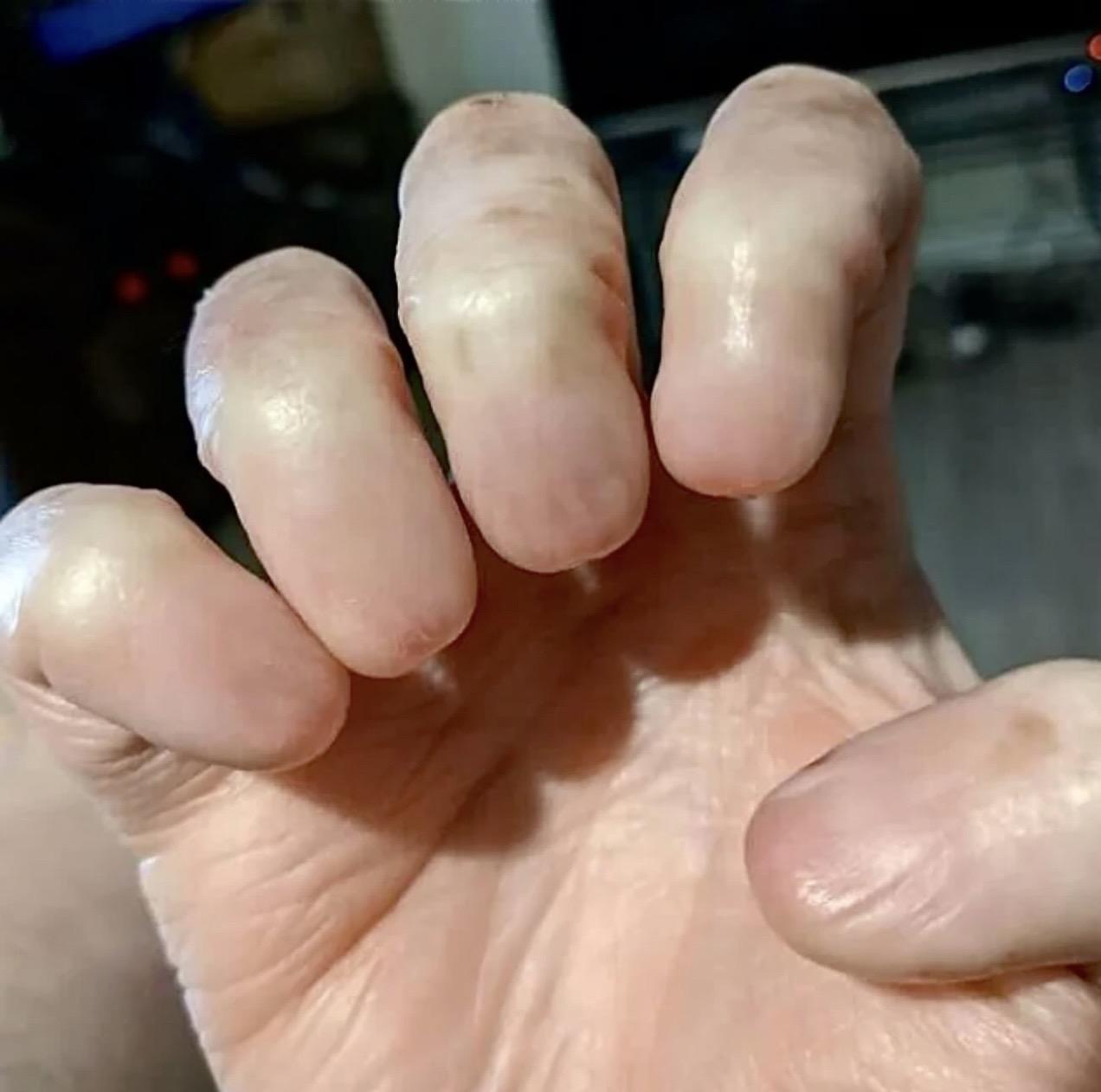 先天没有指甲，你觉得会影响生活吗？先天性无甲症是一种极其罕见的先天性疾病，患者出