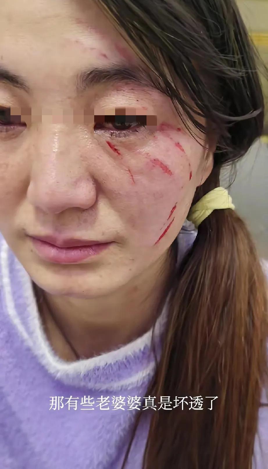 还有谁比我更惨的!婆婆给我破相了!没见过强势的女人,说啥你都要听着不能反抗,
