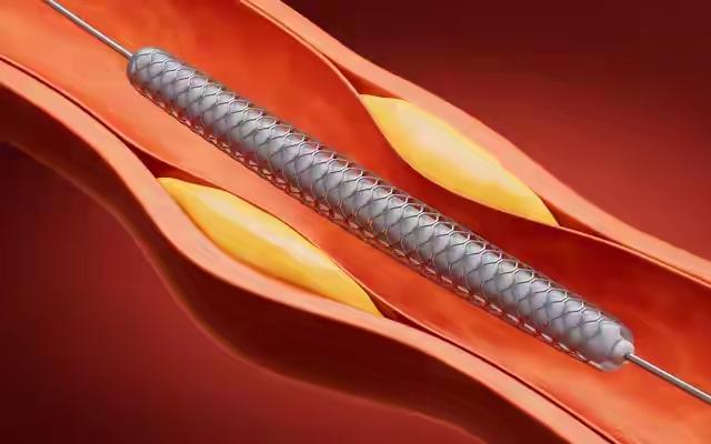 🩺装了心脏支架后，这两件事千万别做！第一件事很多人都没注意——这不是“生活