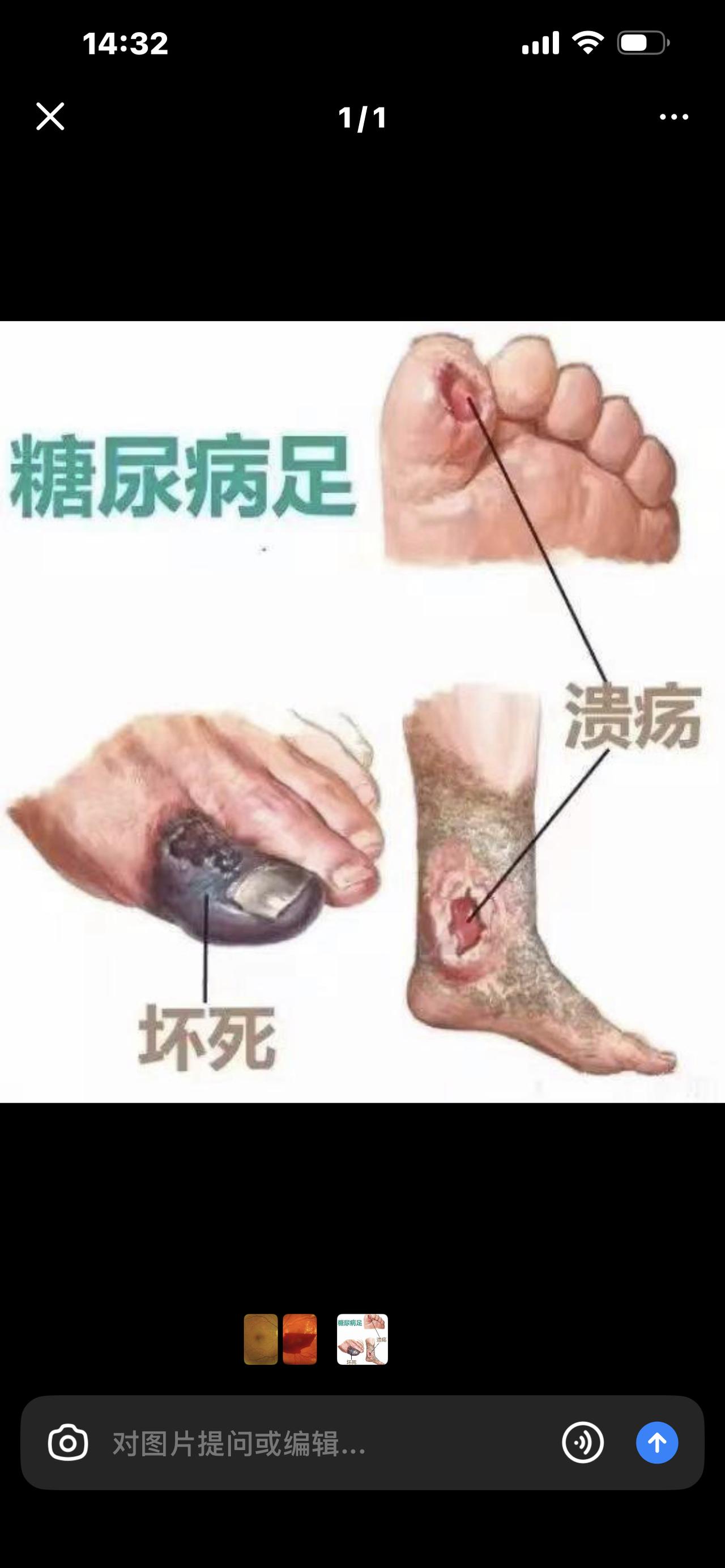 别再被骗了！糖尿病根本不是“血糖高”这么简单，看完吓出冷汗以为糖尿病就是血糖
