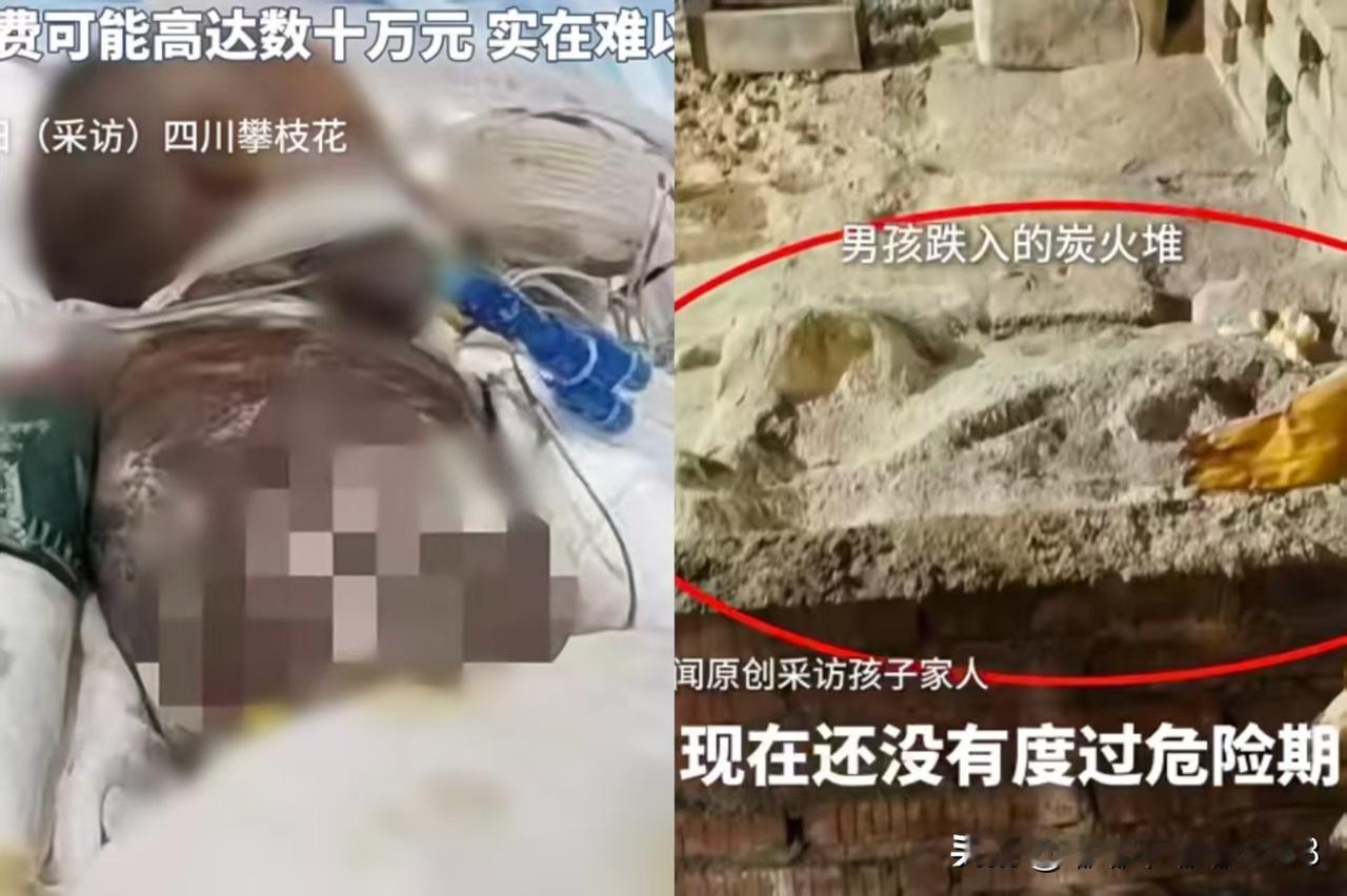 太令人痛心了！这个妈妈要自责死了，3岁孩子竟然跌进炭火堆，更可怕的是孩子还