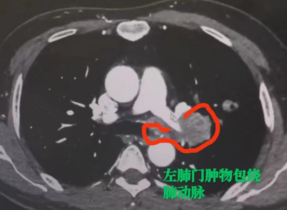 以前，如果一个肺癌患者到了晚期，又查不出对应的基因突变，那治疗选择往往只剩下化疗