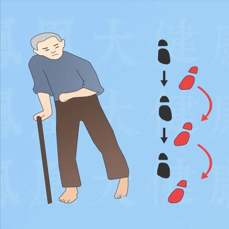 偏瘫走路老往后倒，找对原因恢复更快 1.患侧腿不敢用力偏瘫之后，患侧腿的