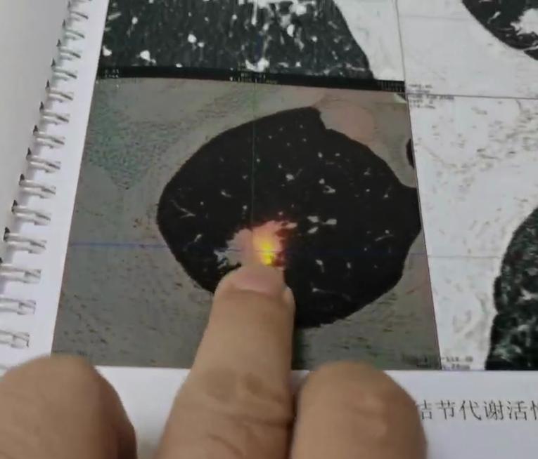 发现肺结节后，并非都需要做PET-CT！尤其是针对小于1cm的小结节，以及密度较