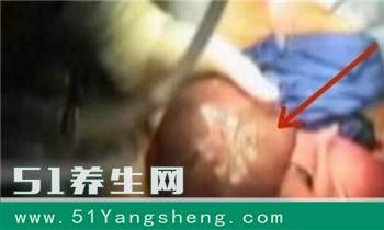 医生划开孕妈腹部, 宝宝“半出世”, 原因是胎儿脚下有这个