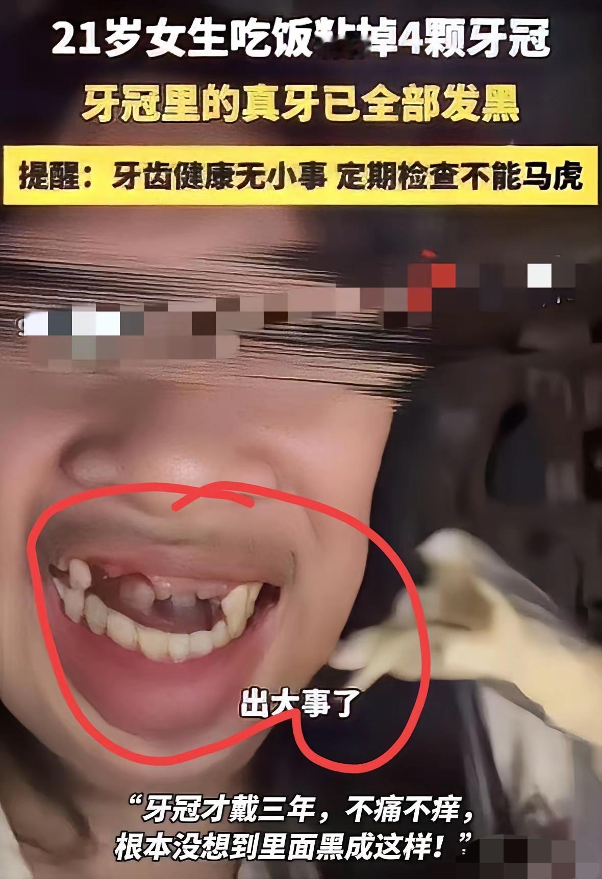 出大事了​福建一个21岁的小姑娘​吃饭的时候嘴里的牙冠一下掉了4个​并且还