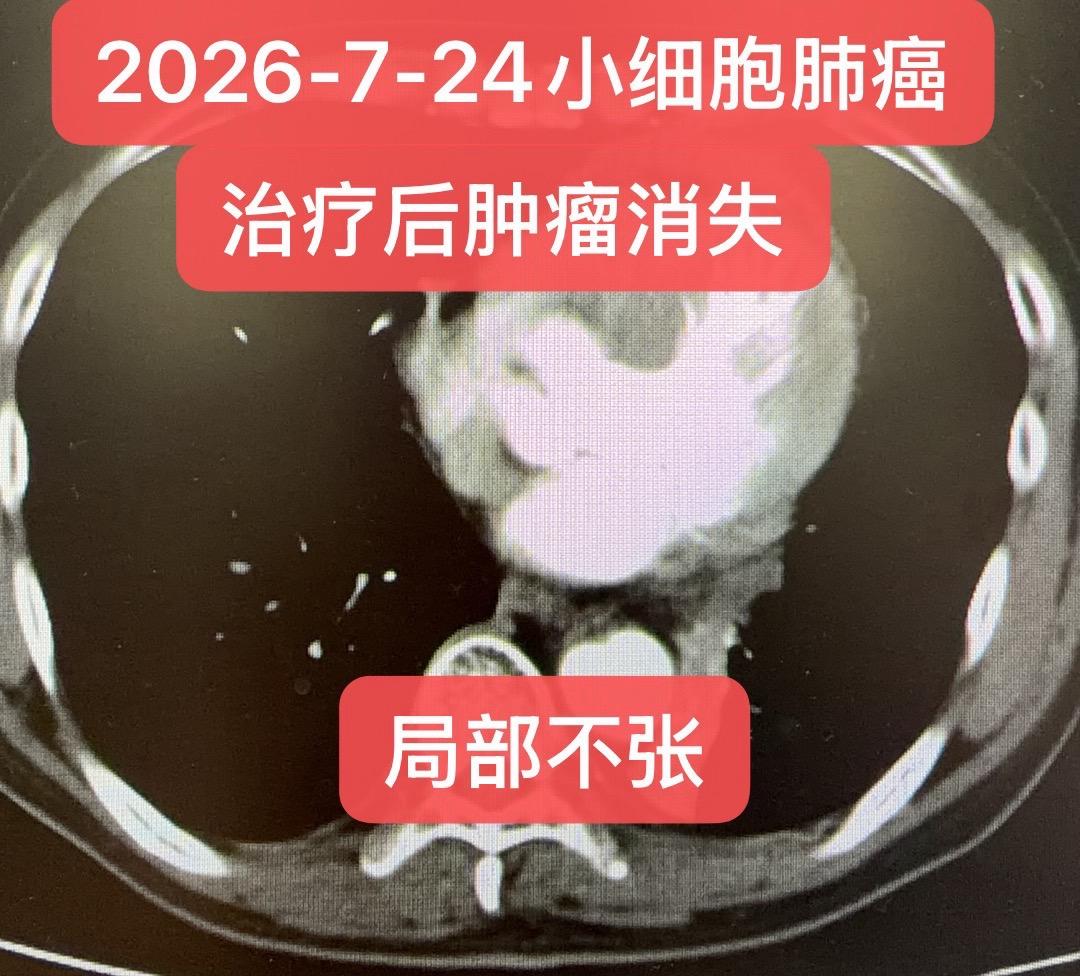 小细胞肺癌的挽救治疗：个案效果。患者，女，57岁，诊断：左肺下叶小细胞...