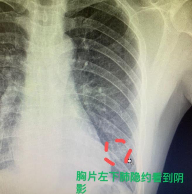 43岁的男性患者,近两年一直断断续续咳嗽,但始终没找到原因。之前做过胸片检查,结