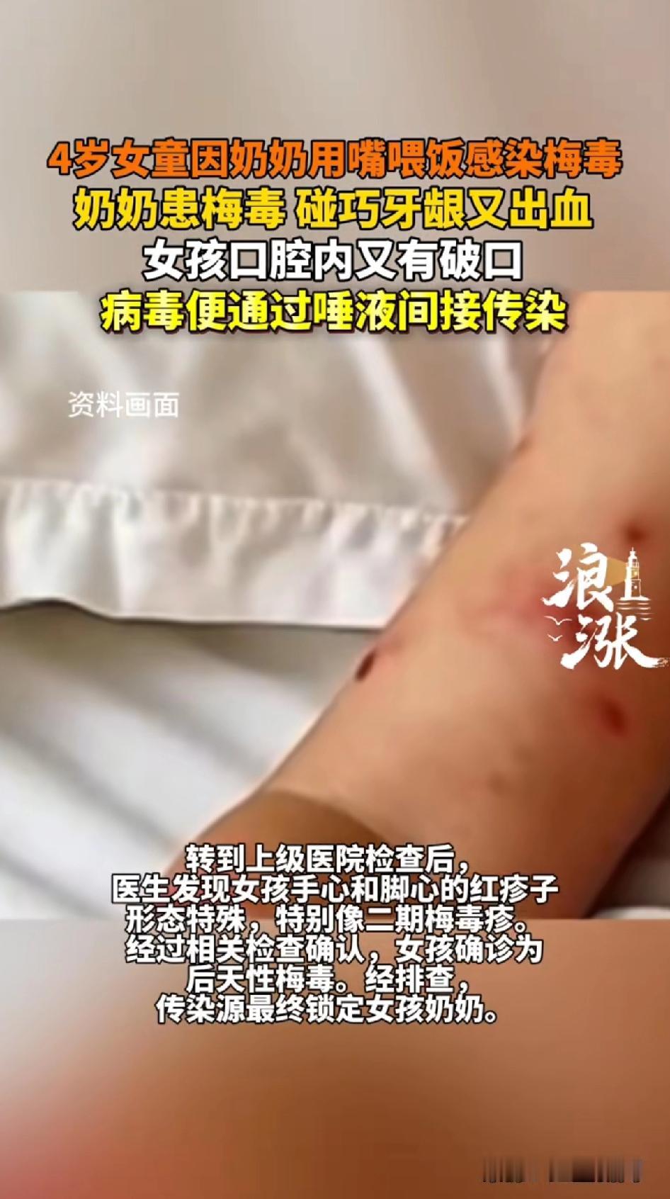 4岁女童因奶奶用嘴喂饭感染梅毒，奶奶患梅毒，又碰巧牙龈出血，女孩口腔有破口，病毒