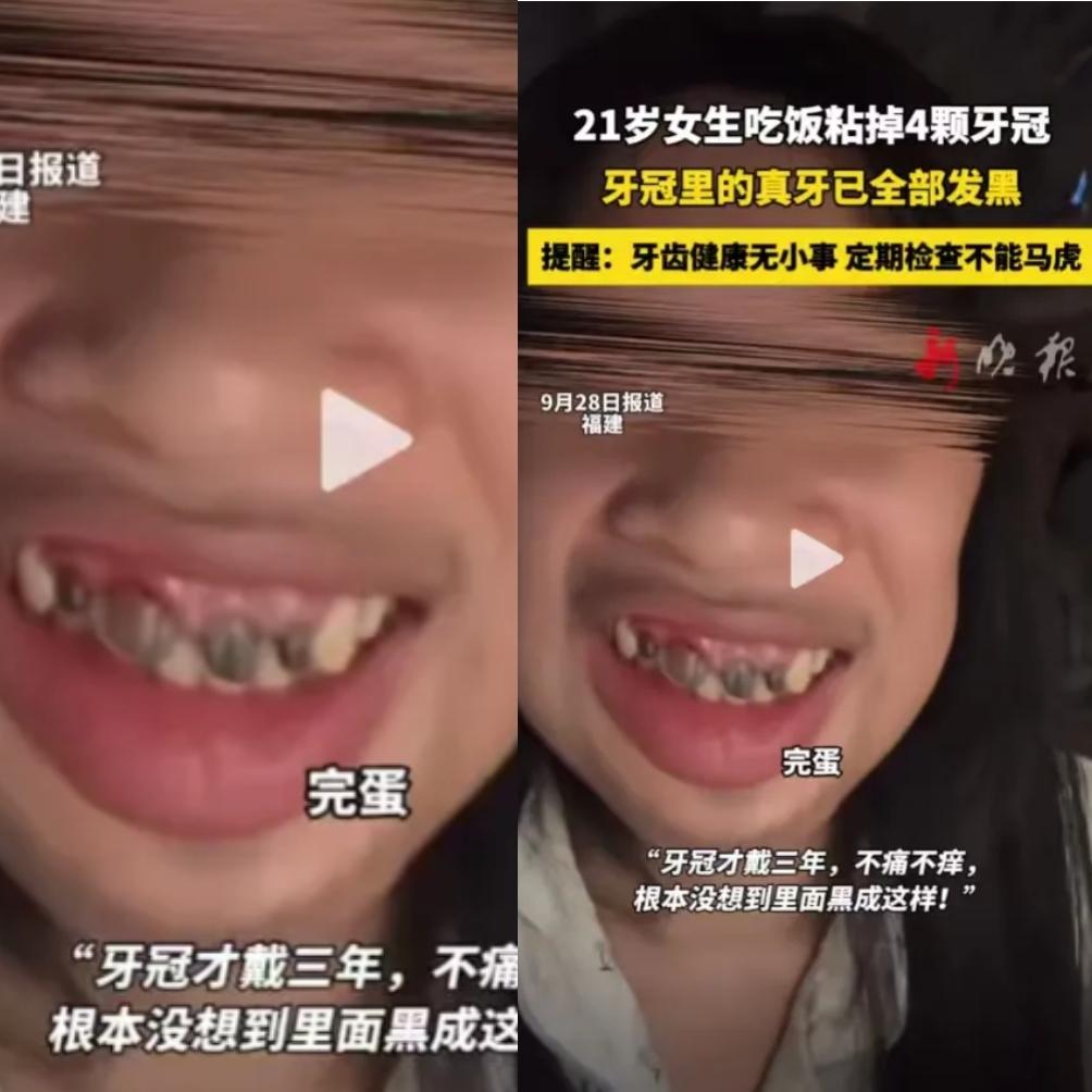 天塌啦！不仅福建知道了，全国都知道了！21岁女生吃饭掉4个牙冠！真牙全发黑的