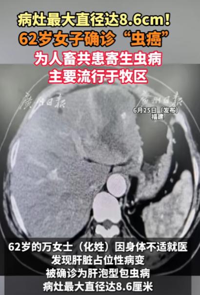 “给所有养宠家庭敲醒警钟！”福建一名62岁的万女士，就因为常年和宠物零距离相处，
