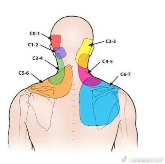 为什么颈椎病会头疼你们会不会经常头疼？包括颈部僵硬、一动脖子咔咔响，手还麻的症