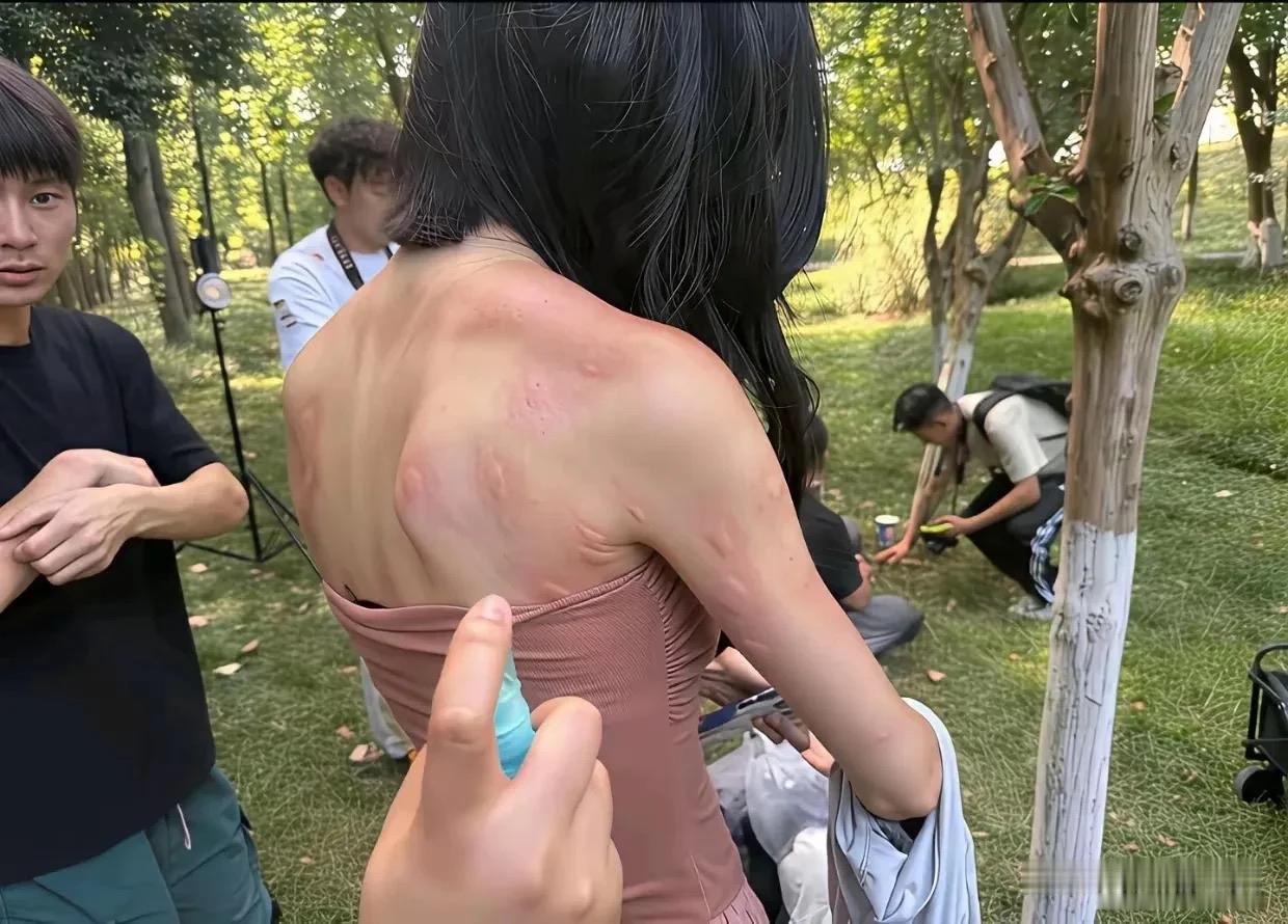 真的看着都心疼！小姑娘后背瘦得皮包骨头，没想到蚊子一点都不挑剔，咬出密密麻麻的大
