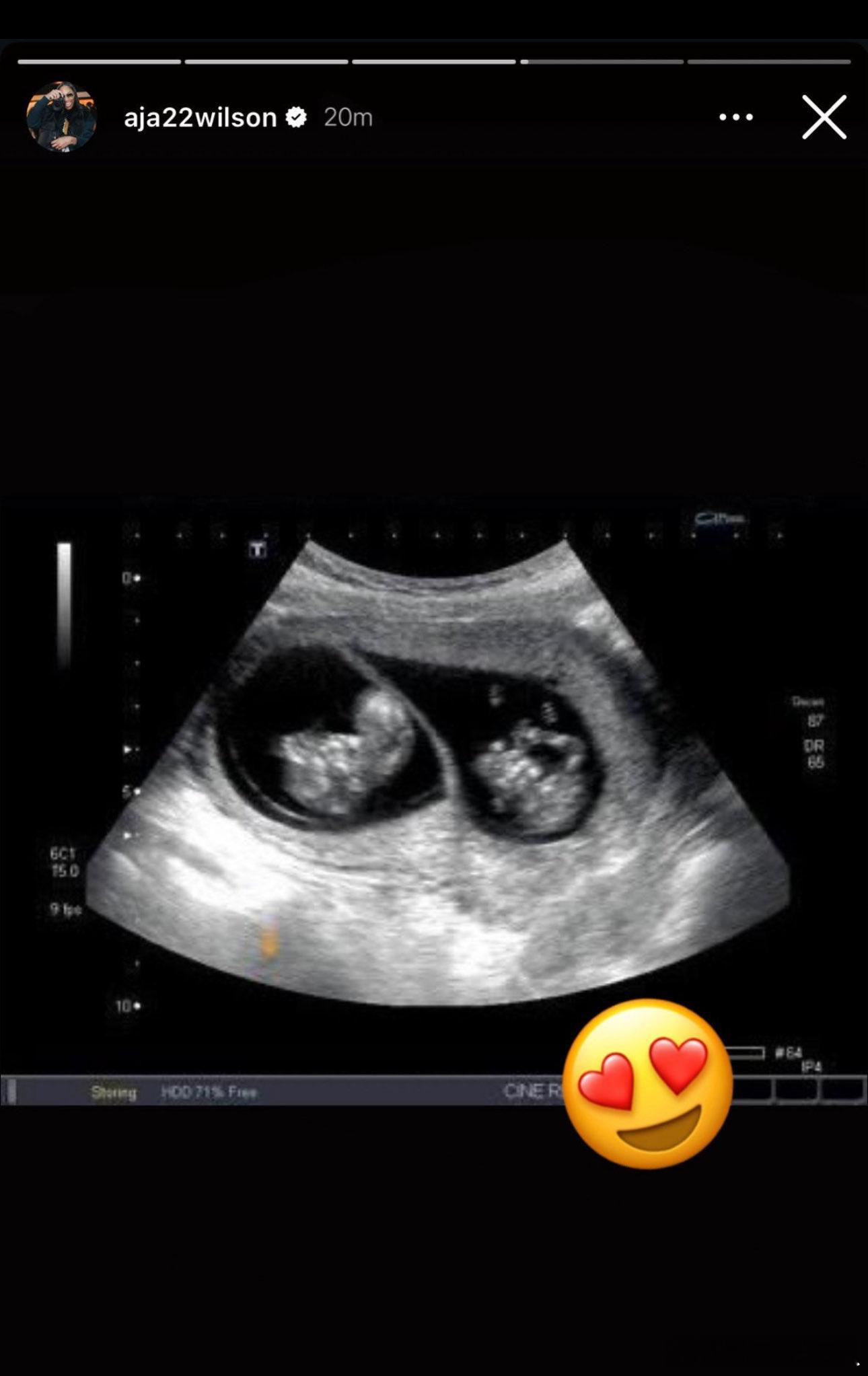 阿德巴约女友怀孕阿德巴约女友，WNBA巨星阿贾-威尔逊宣布自己怀孕，还是双胞胎