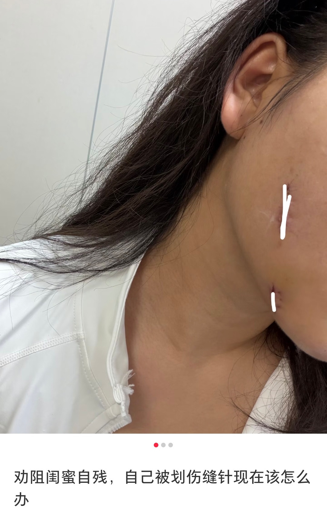 天呐，这个贴主阻止闺蜜自can导致自己被划伤，现在跟这个闺蜜因为医药费闹掰了……