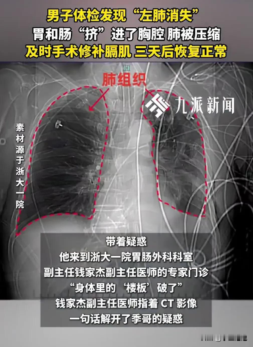 11月9日，据九派新闻报道，浙大一院接诊的季哥（化名），平时身体硬朗很少就医，因