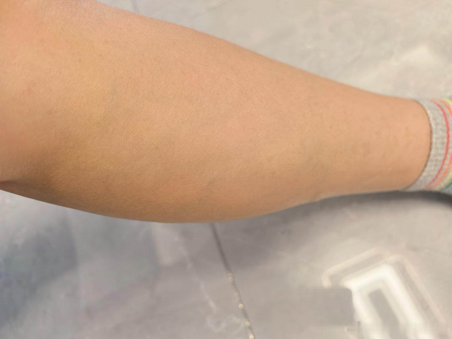 这小腿肚子除了粗点也看不出啥问题啊，没磕没碰的疼好几天了，尤其一蹲下再起来，是真