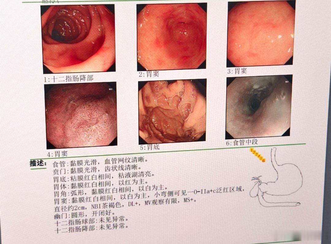 这位患者2年前，做的胃镜还是萎缩性胃炎，当时根除了HP，今年复查，病理为低级别瘤