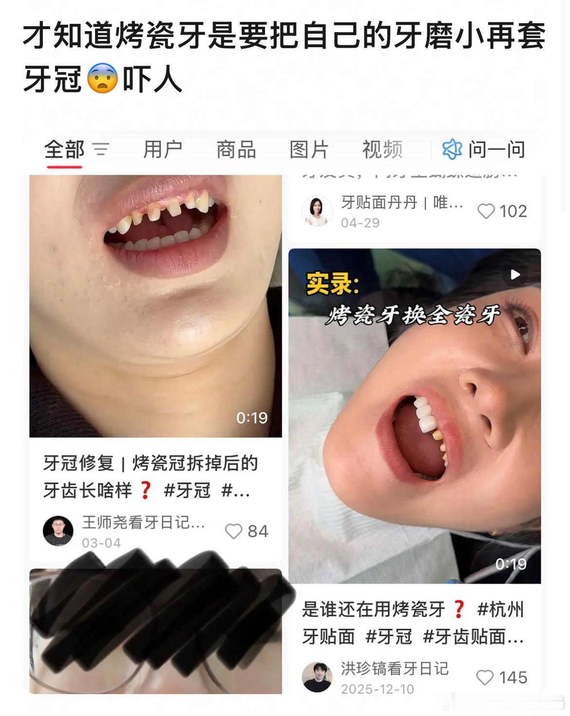才知道烤瓷牙是要把自己的牙磨小再套牙冠好可怕