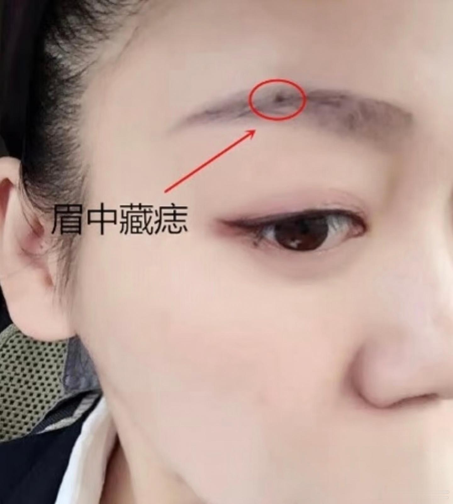眉里藏珠眉毛里的痣常称“眉里藏珠”，多视为吉兆，但具体命运说法会随痣的位置、形态