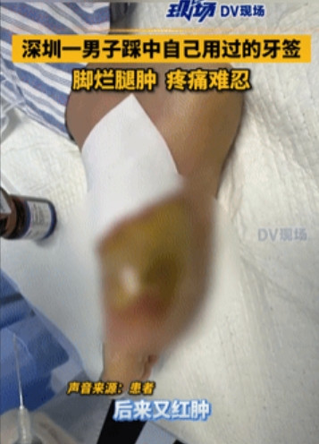 太吓人了！广东，男子不小心踩中了自己用过的牙签，眼看伤口就一个小洞，也没怎么出血