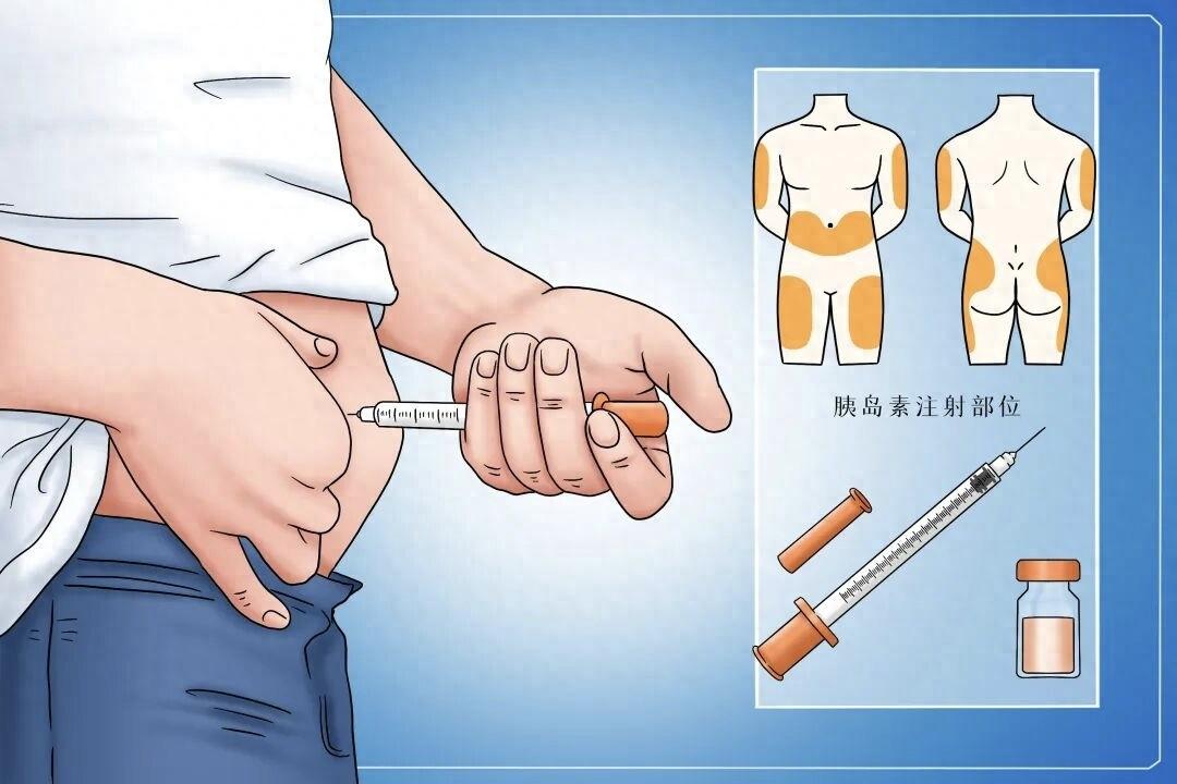 为什么打上胰岛素血糖还是降不下来？看看是不是这4个原因造成的很多人以为只要用