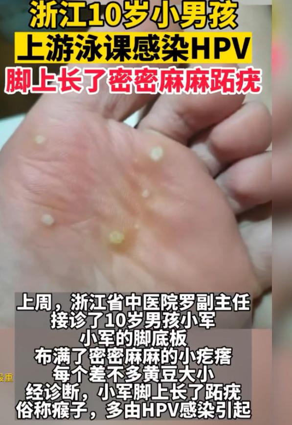 警惕！浙江，一妈妈给10岁儿子报了游泳班，结果孩子游完泳后脚底板竟密密麻麻长满了