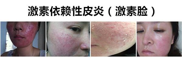 激素脸怎么办? 激素脸反复过敏, 起疹子, 发红, 发烫