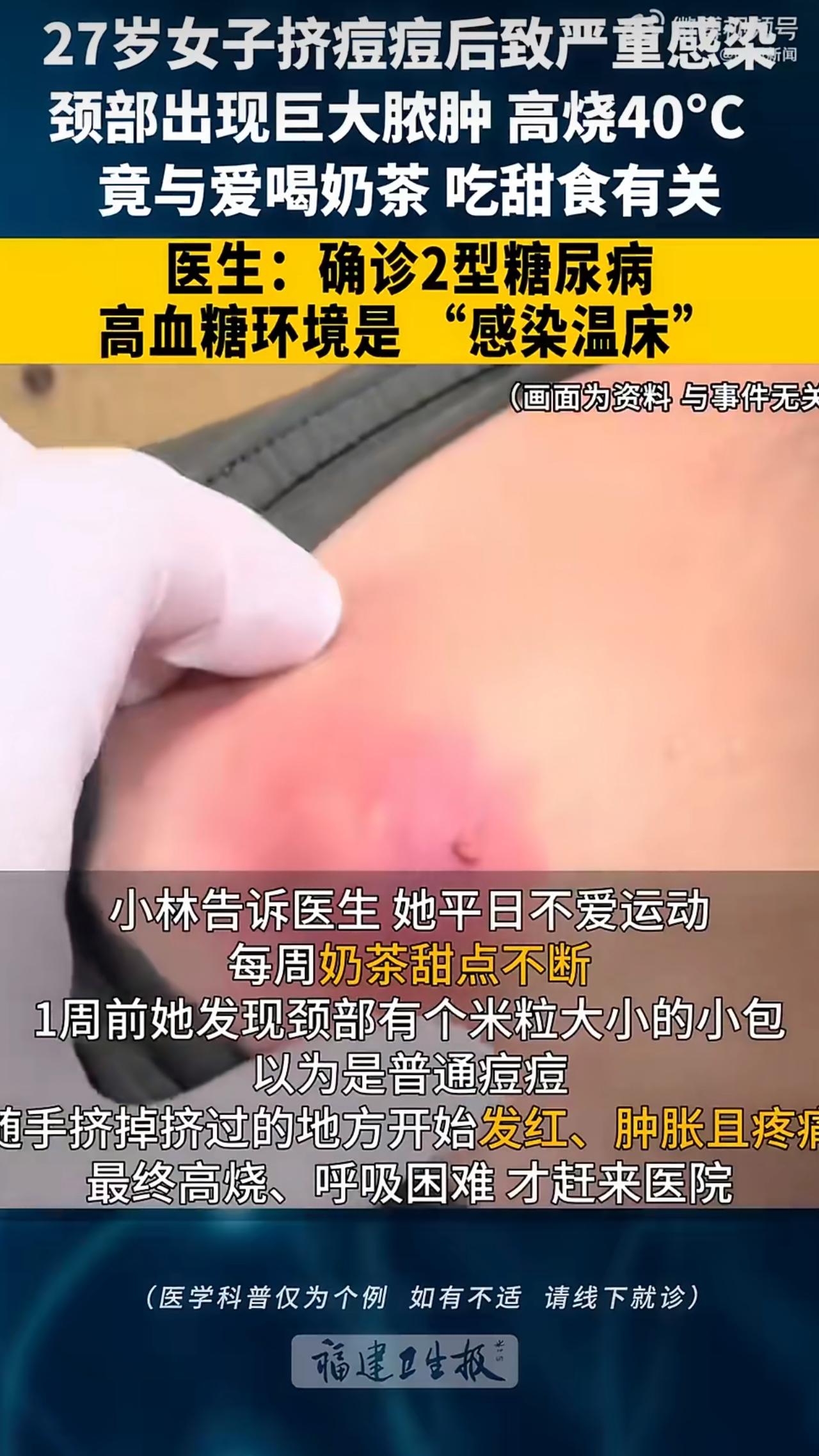 27岁的小林因为随手挤了颗脖子上的痘痘，结果高烧到40℃，脖子肿得像馒头，最后竟